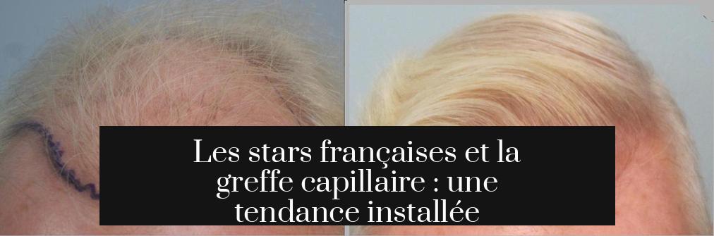 Les stars françaises et la greffe capillaire : une tendance installée
