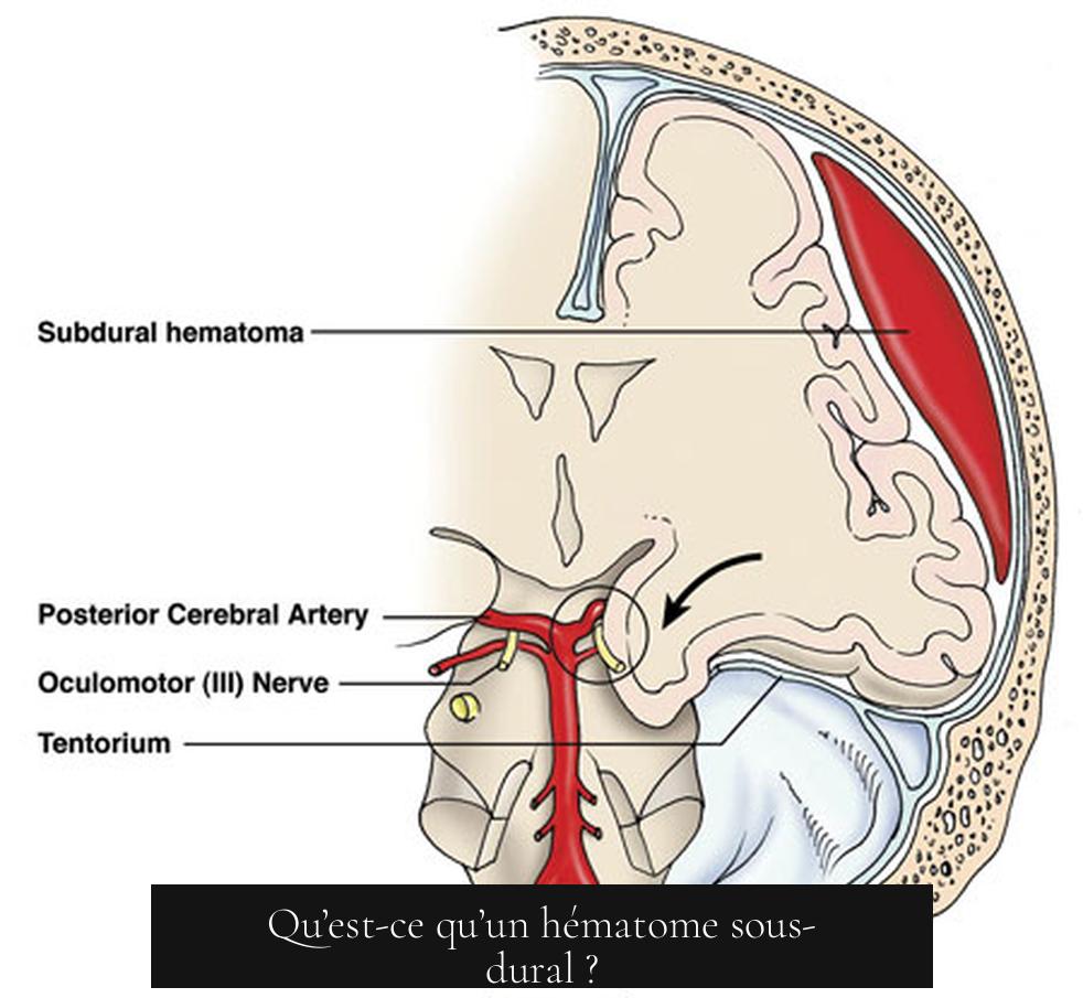 Qu’est-ce qu’un hématome sous-dural ?