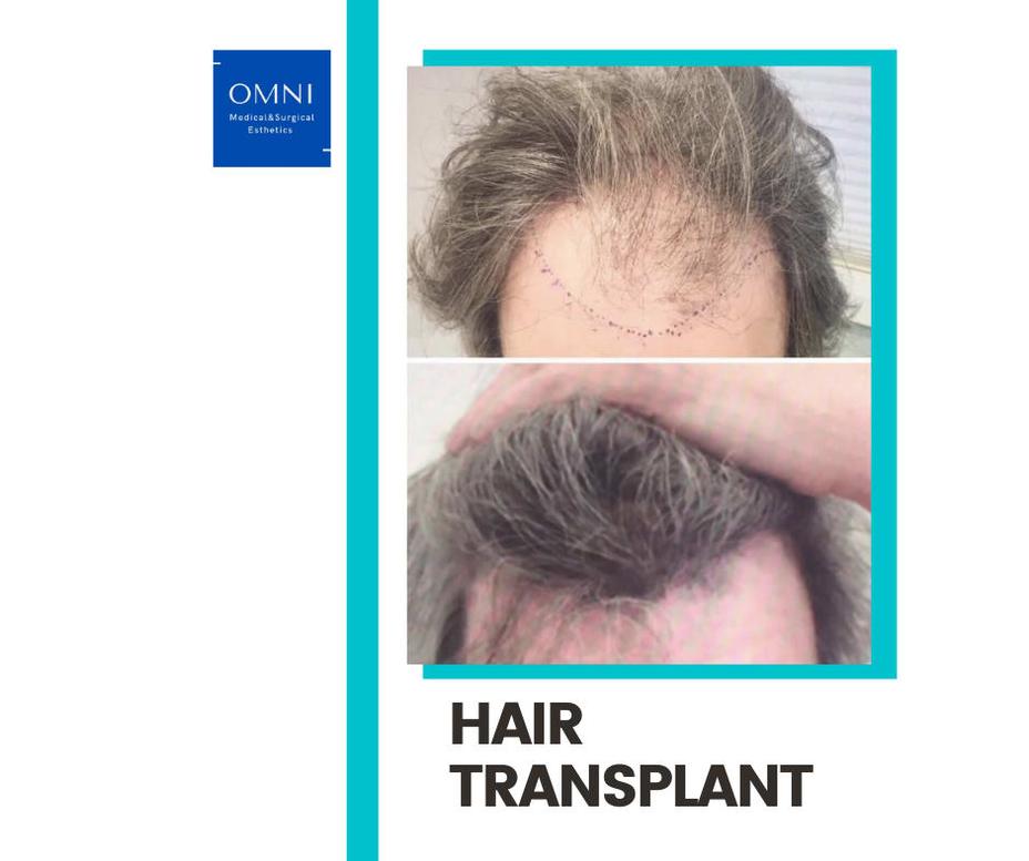 Cyril Lignac et les implants capillaires : Que se cache-t-il derrière cette transformation capillaire ?