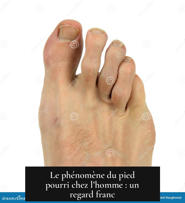 Le phénomène du pied pourri chez l’homme : un regard franc