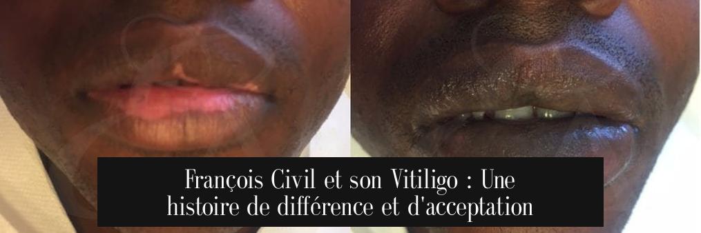 François Civil et son Vitiligo : Une histoire de différence et d'acceptation