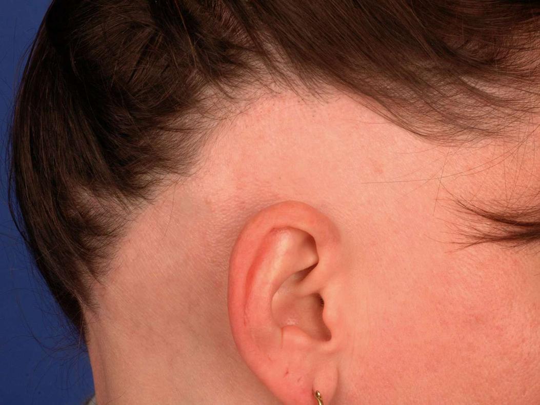 Quelles sont les causes courantes de perte de cheveux chez une fillette de 6 ans ?