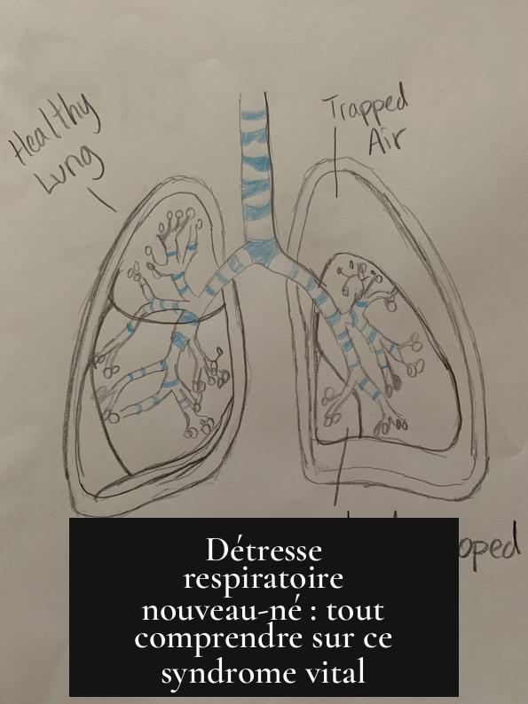 Détresse respiratoire nouveau-né : tout comprendre sur ce syndrome vital